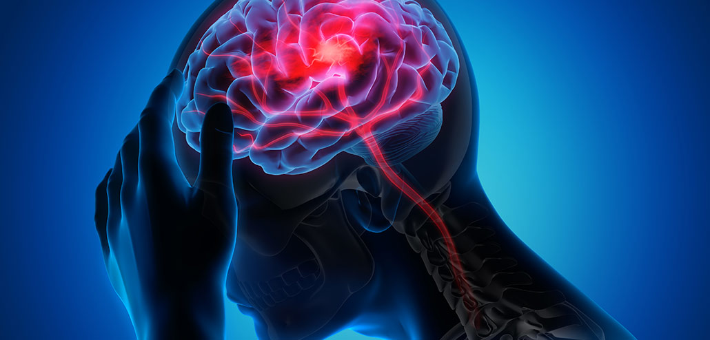 meningiomi e aneurisma cerebrale